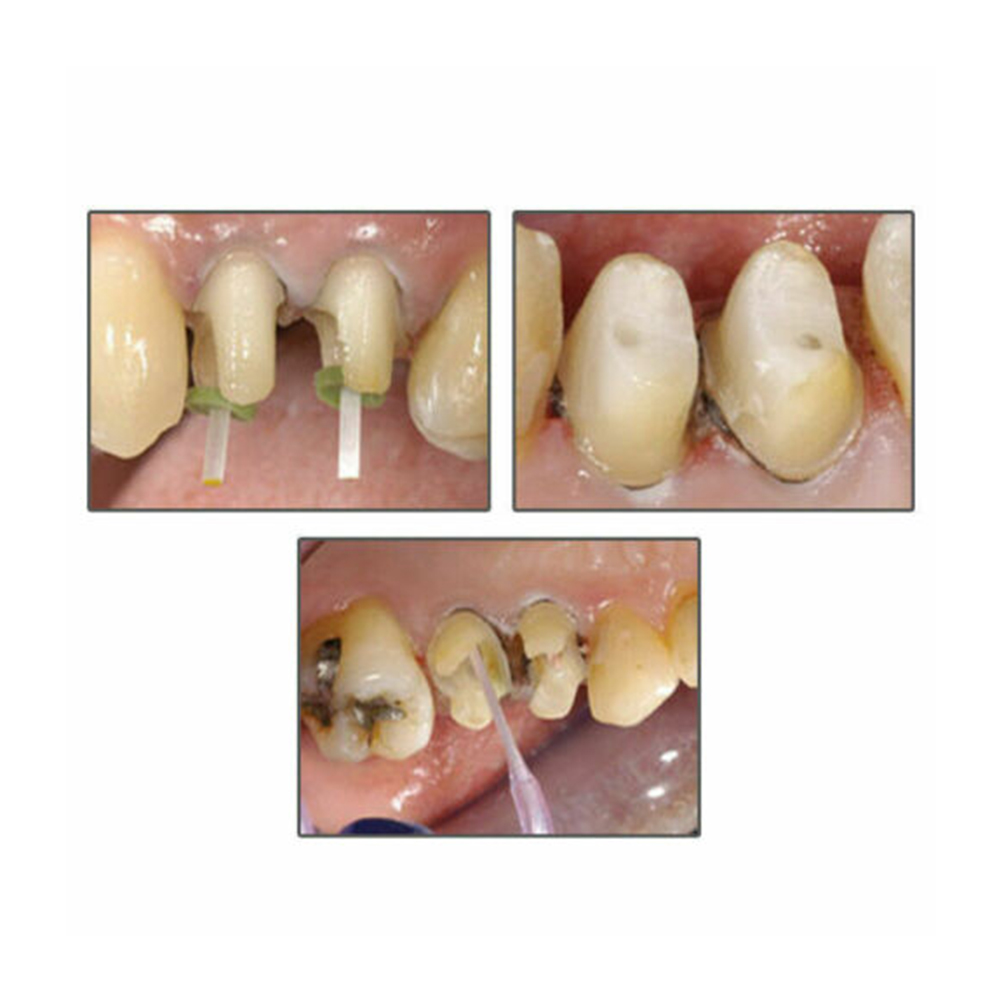 Fiber Post With 4 Drills ( Pack of 20 Posts )