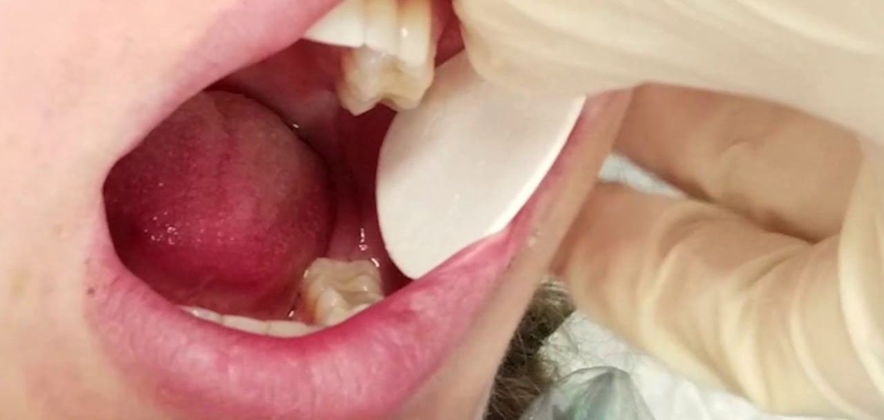 Capri Cheek Dry Guard Plain Small 200/pk