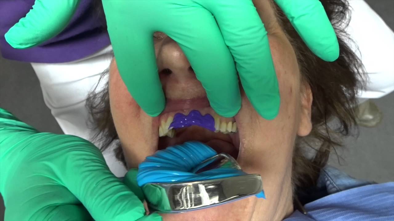 Bio-Art Dentulous Non-Perforated Impression Trays (Set of 6) AMLD0764