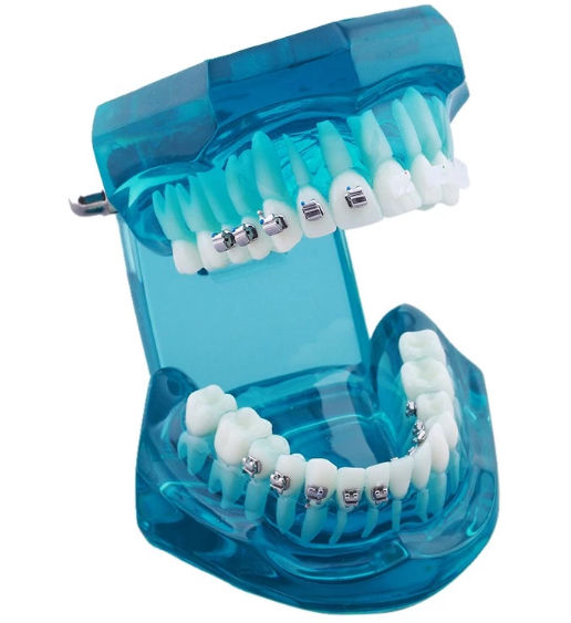 iDENTical Self Ligating Model M3012 Blue