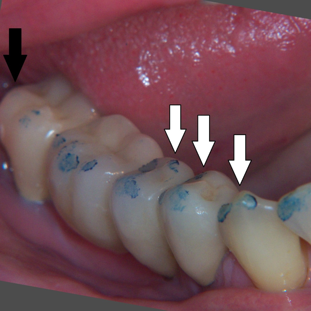 MDM Dental Articulating Paper