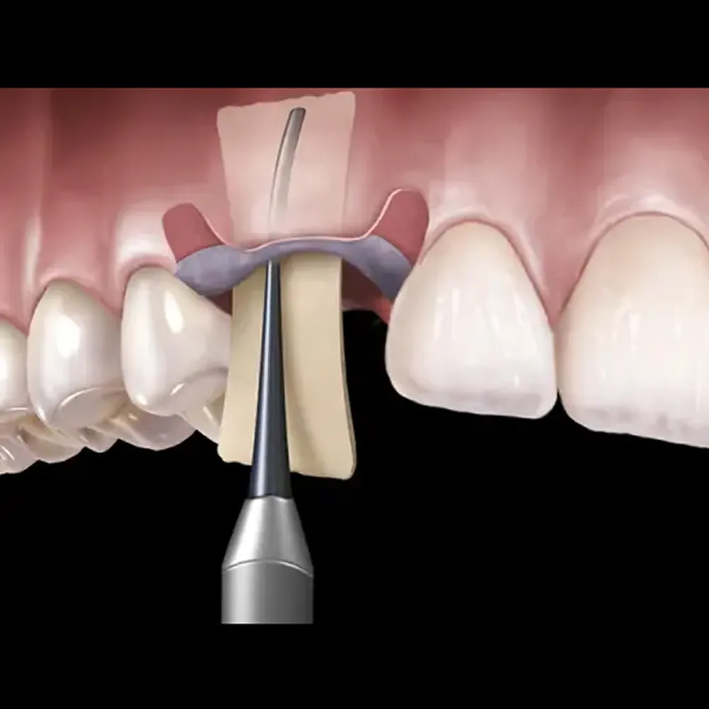 Oracraft Membrane Placement (PMPIS)
