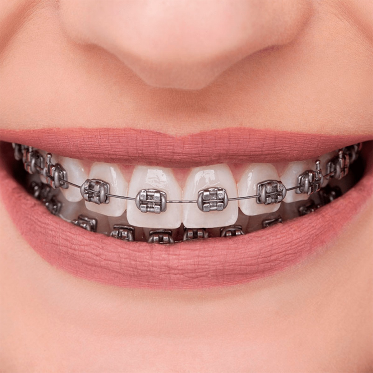 OrthoMetric Advanced Series Metal Bracket Promotional Kit MBT 022 - 10 Cases + Archwires + Stick Ligatures (10.11.2802)