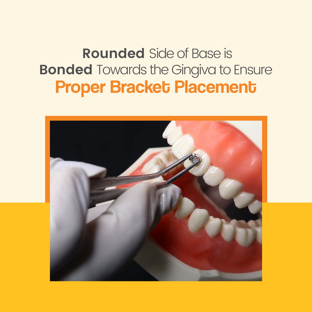 Waldent Metal Bracket Kit MBT 022 Slot