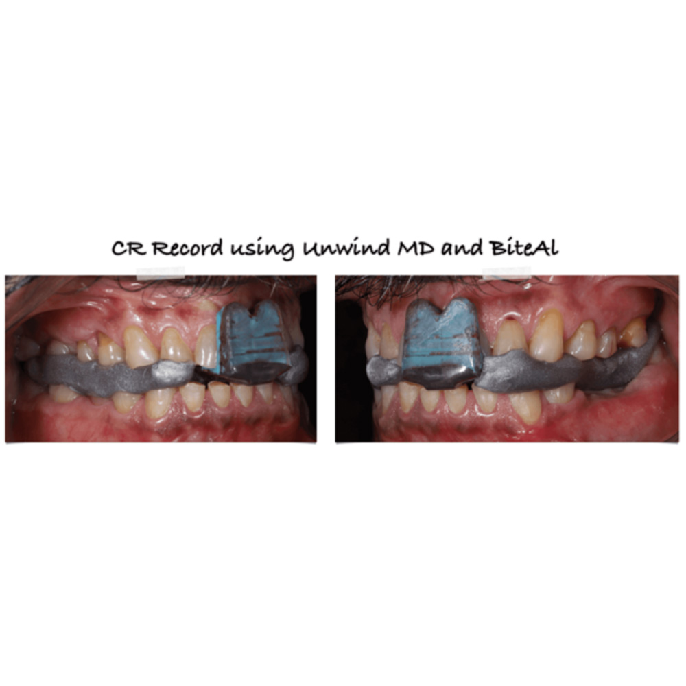 MiK Bite AI Bite Registration Wax (Pack of 2)