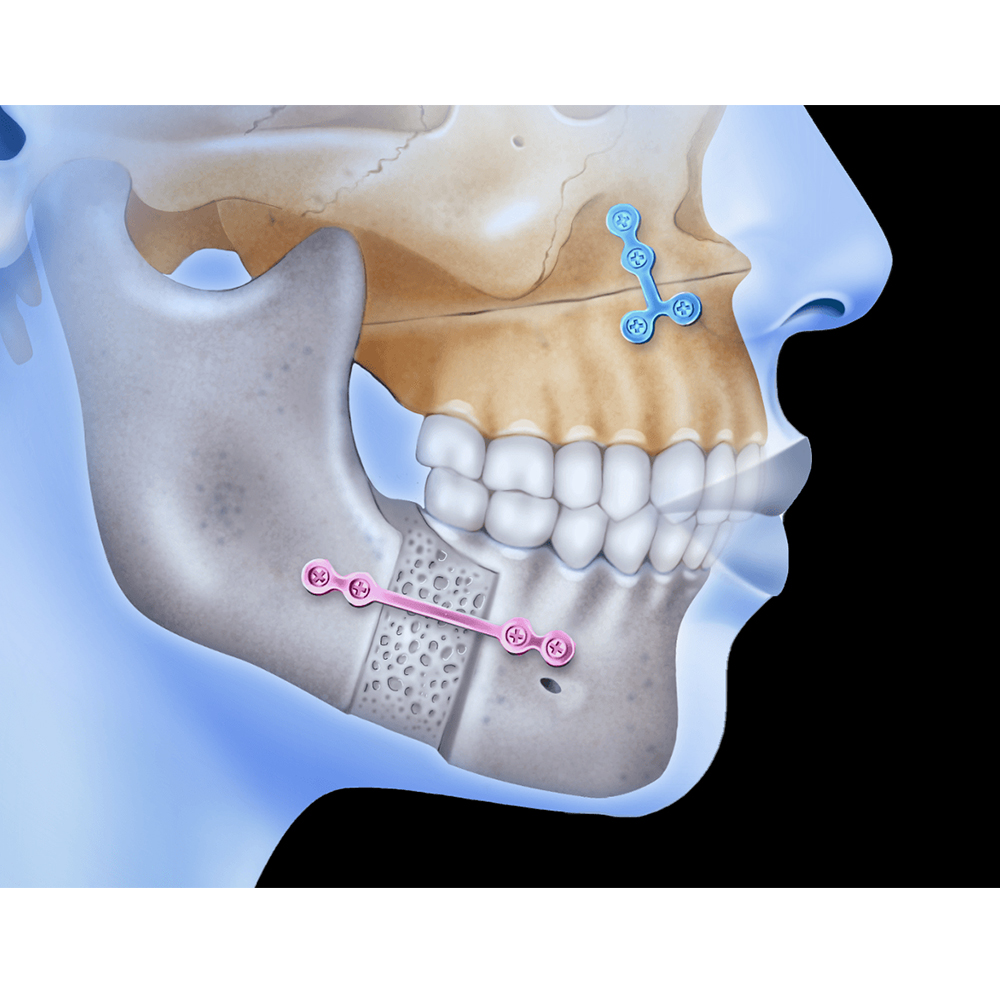 SK Surgicals SS Mini Bone Plates T Shape With Gap - 1.5mm