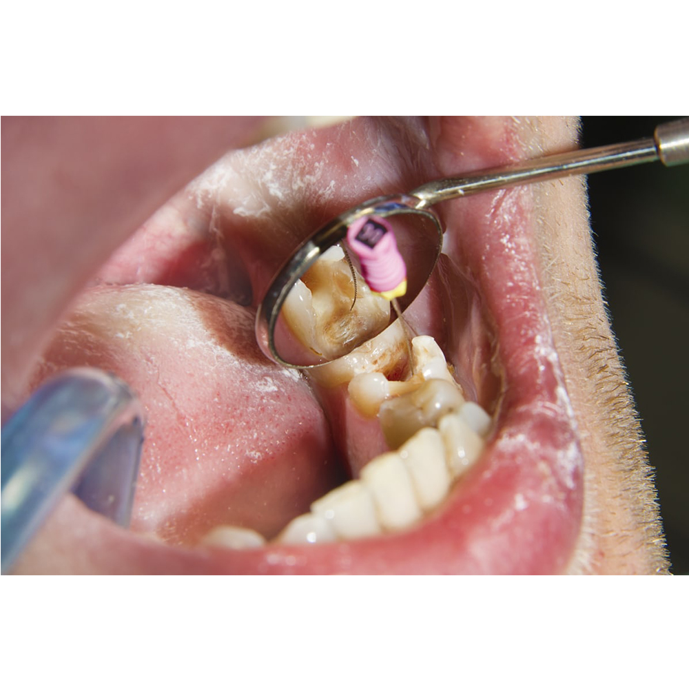 GDC Mouth Mirror Tops Plain Pack Of 12 Pcs - 3 (Mmtp3)