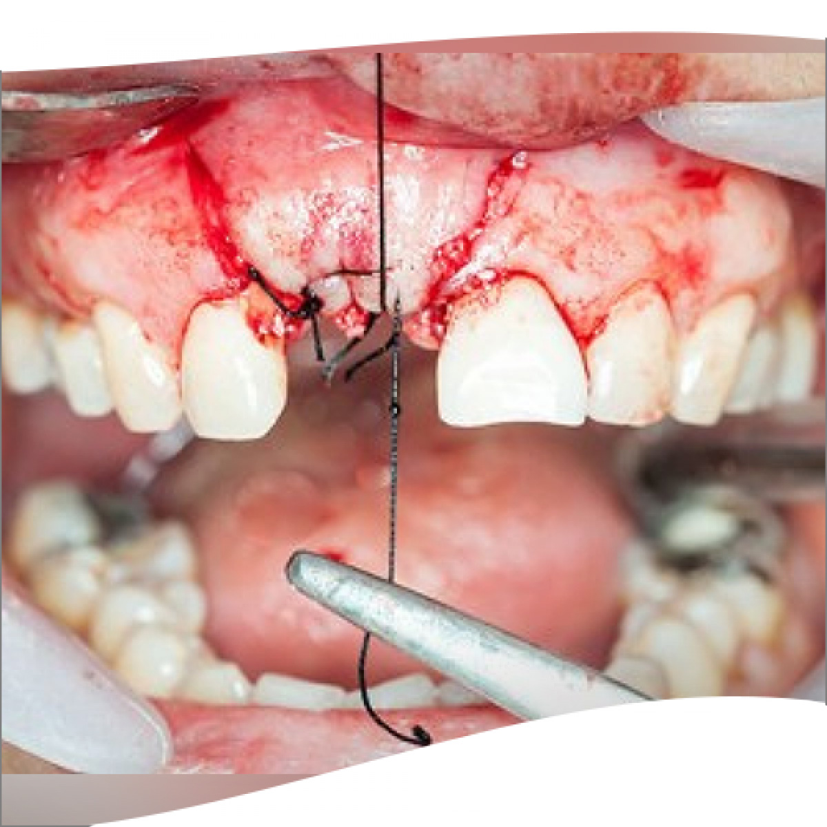 Meril Filapron #2-0 Polyglecaprone 25 Suture