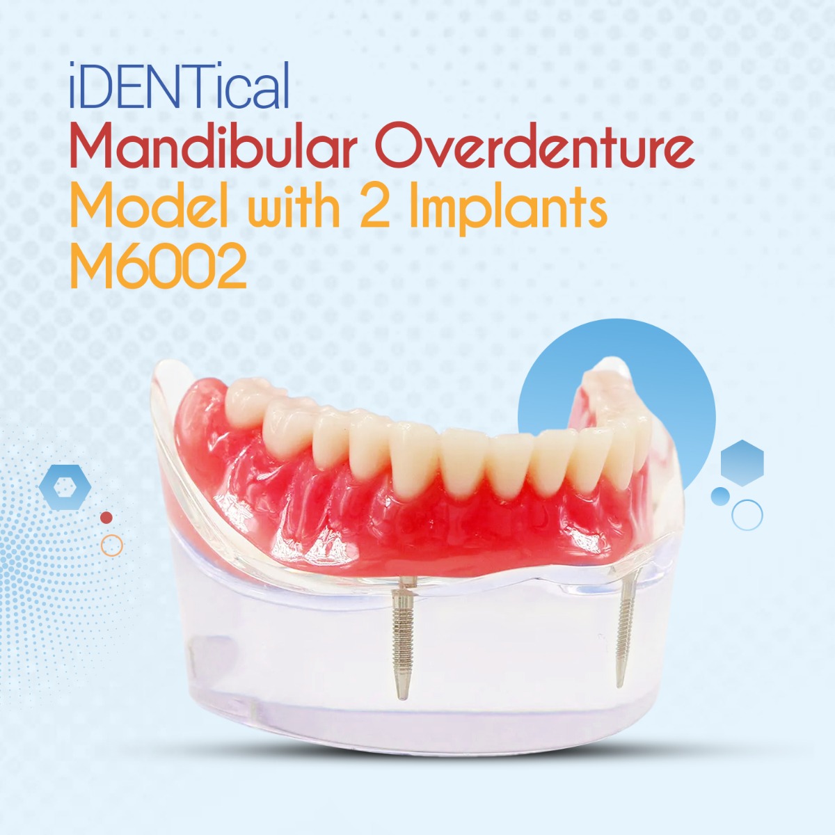 iDENTical Mandibular Overdenture Model with 2 Implants M6002