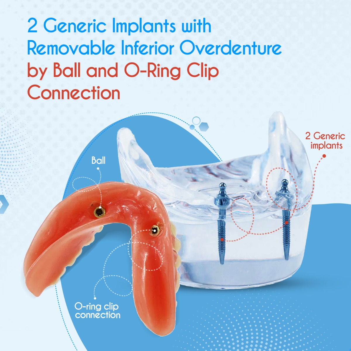 iDENTical Mandibular Overdenture Model with 2 Implants M6002