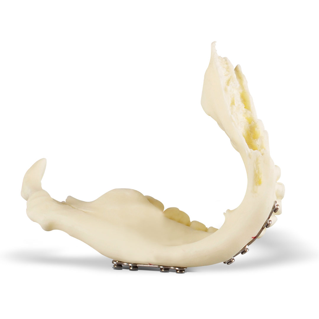 iDENTical Jaw with Titanium Plate Model M5001