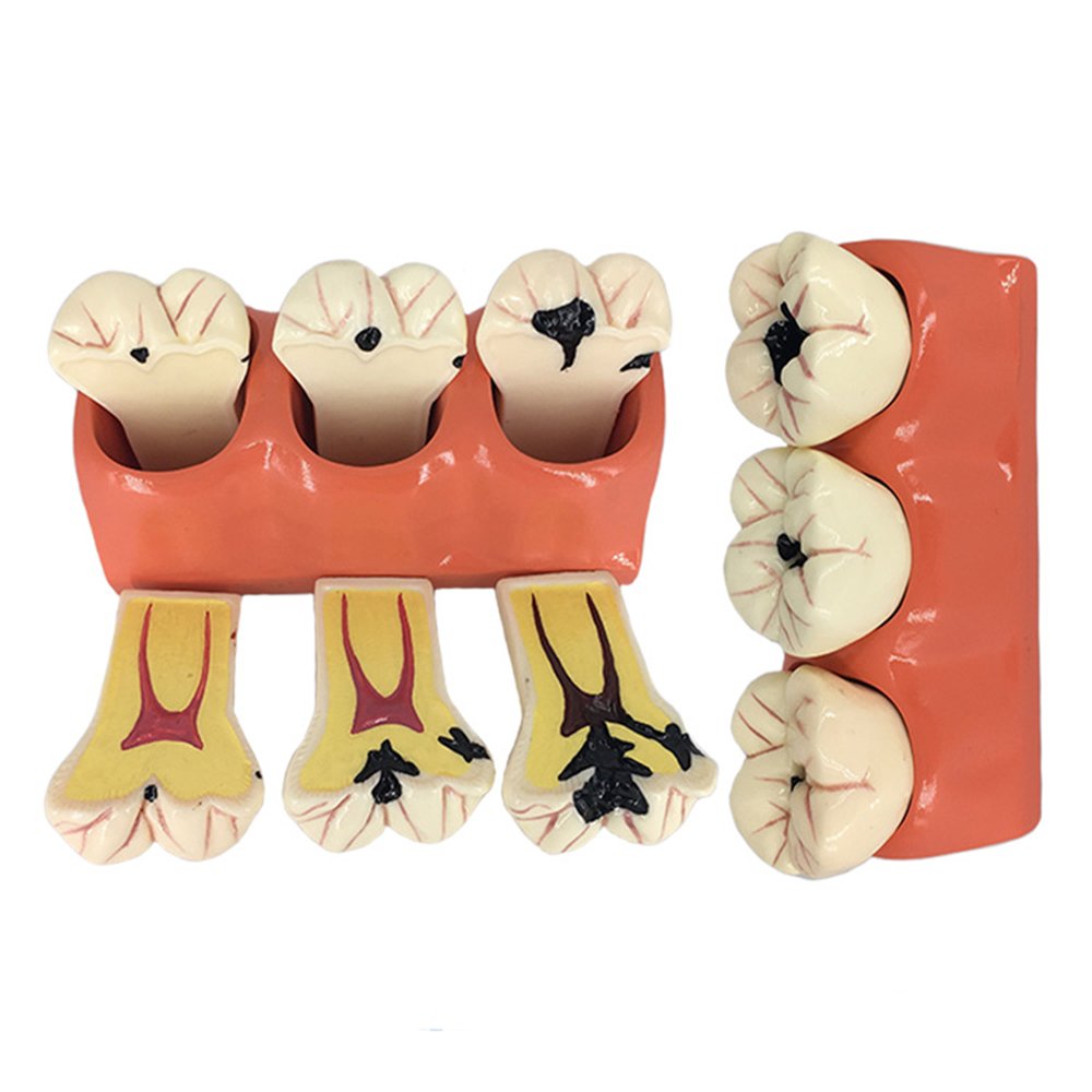 iDENTical Caries Development Tooth Model M4020