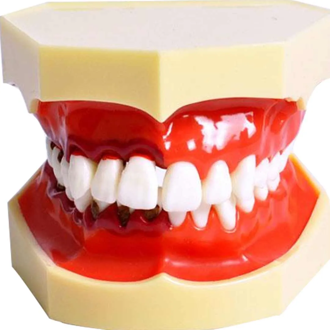 Buy Identical M4025 Periodontal Disease Model : With Realistic 