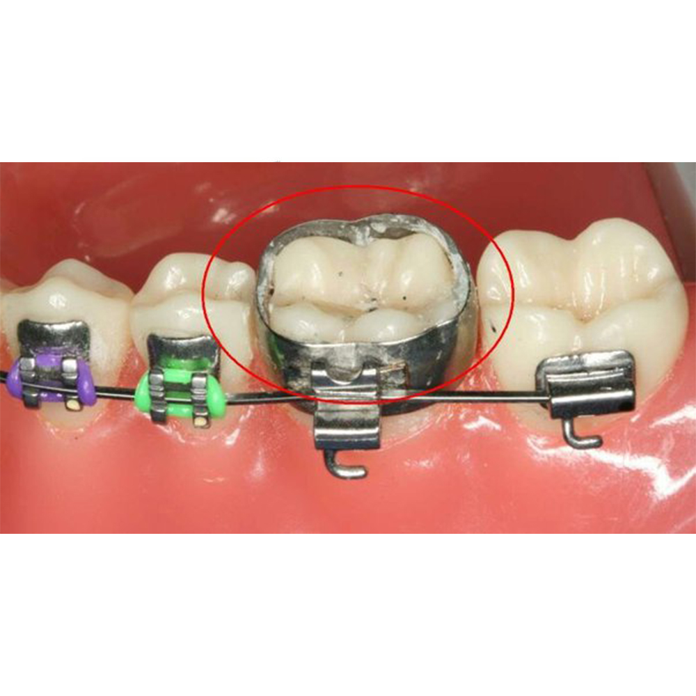 Syden Preformed Molar Band With Prewelded Mbt Buccal Convertible Tubes Pack Of 4 Pcs