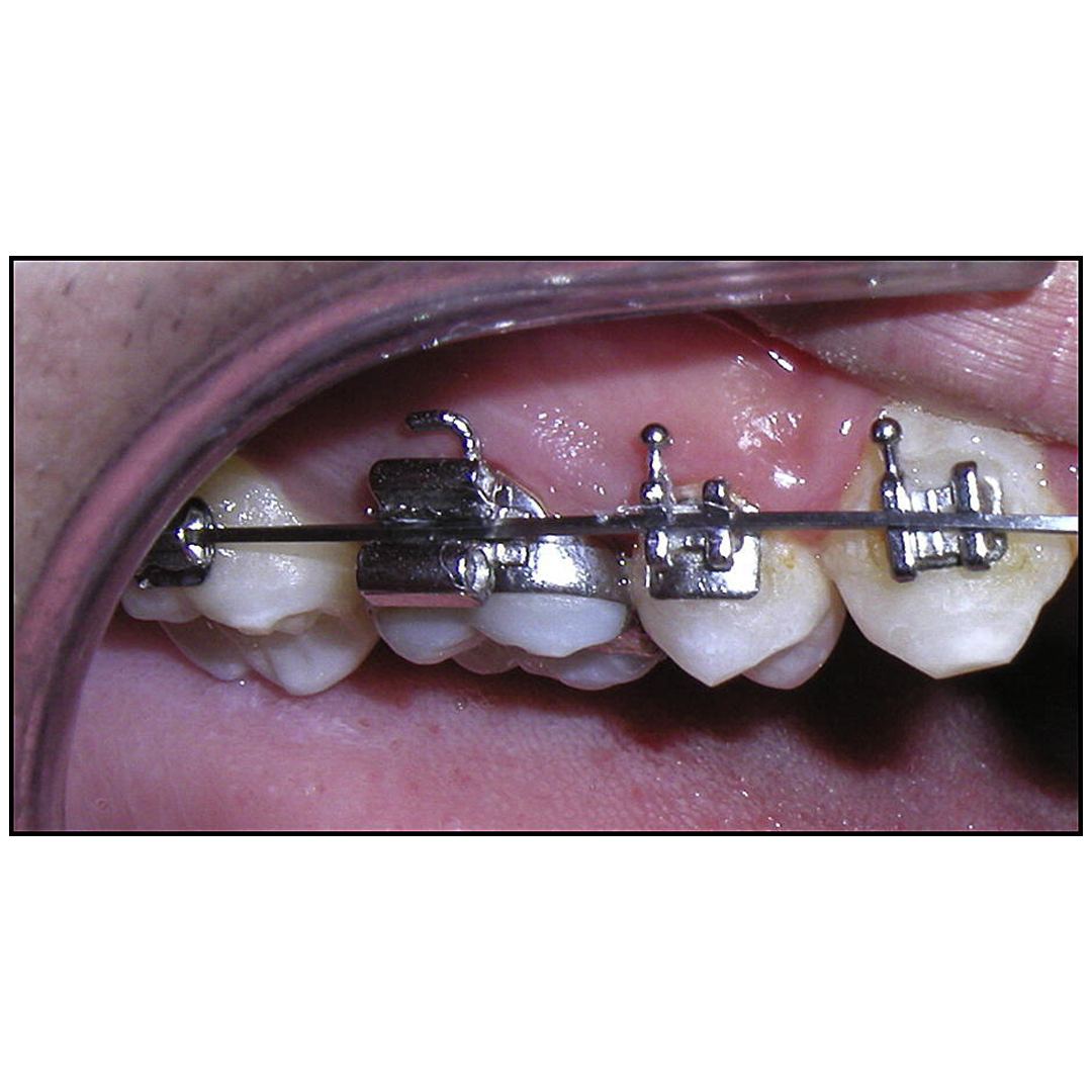 OSL 1st Molar Prewelded Molar Bands Roth 0.018 U3/L2 (Pack Of 4)