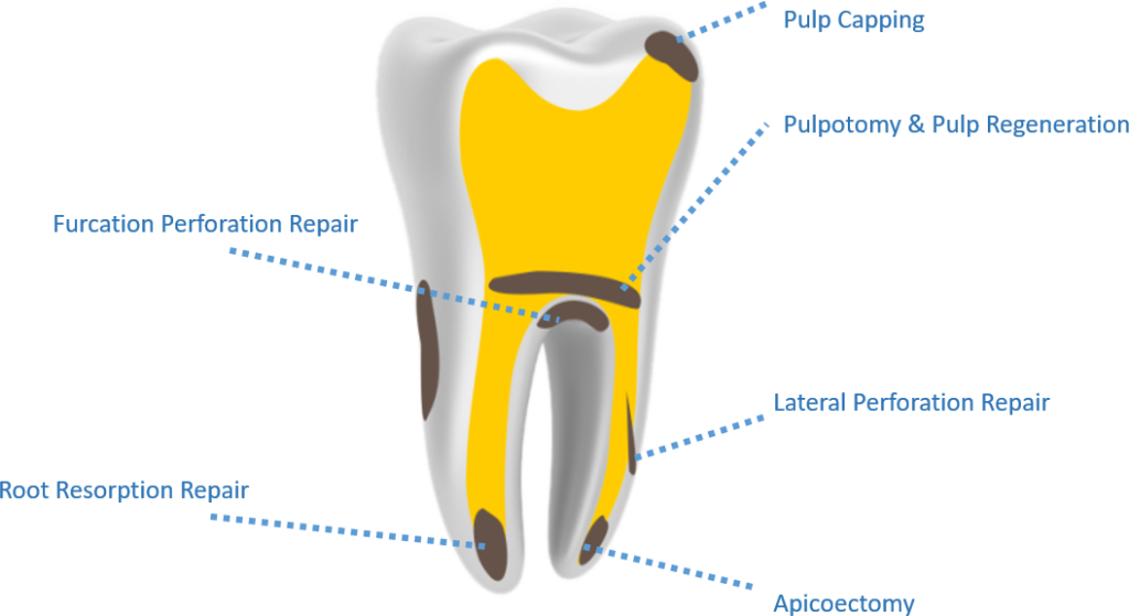 Kids-e-Dental E-MTA (Mineral Trioxide Aggregate)