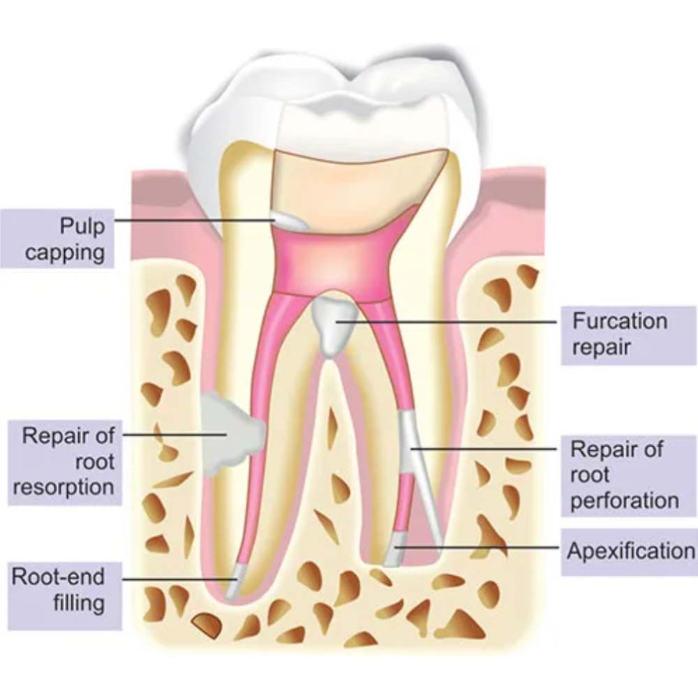 Kids-e-Dental E-MTA 1gm