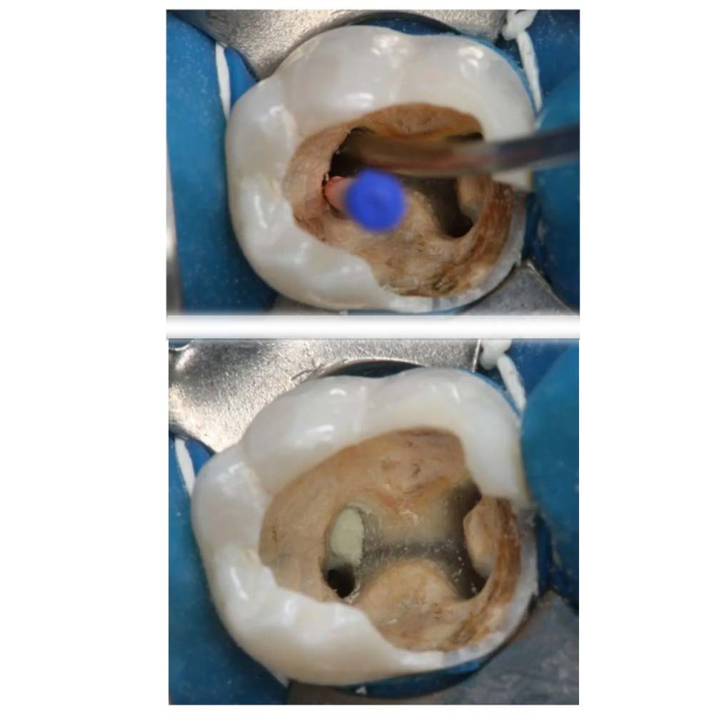 Kids-e-Dental E-MTA 1gm