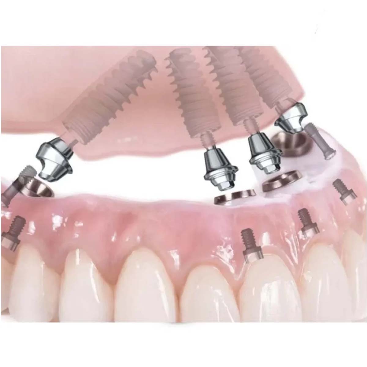 Xcem Conical Multi Angled Abutment - Hex