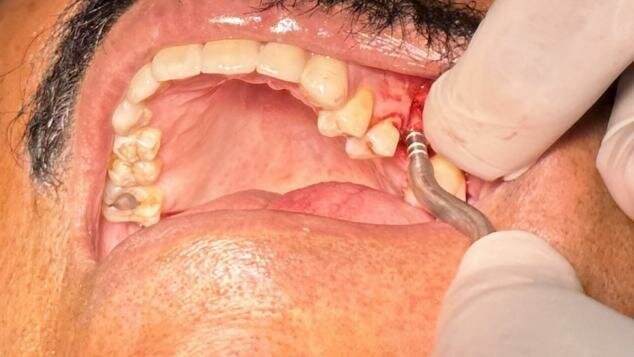 Api+ Osteotomes Convex With Stoppers 