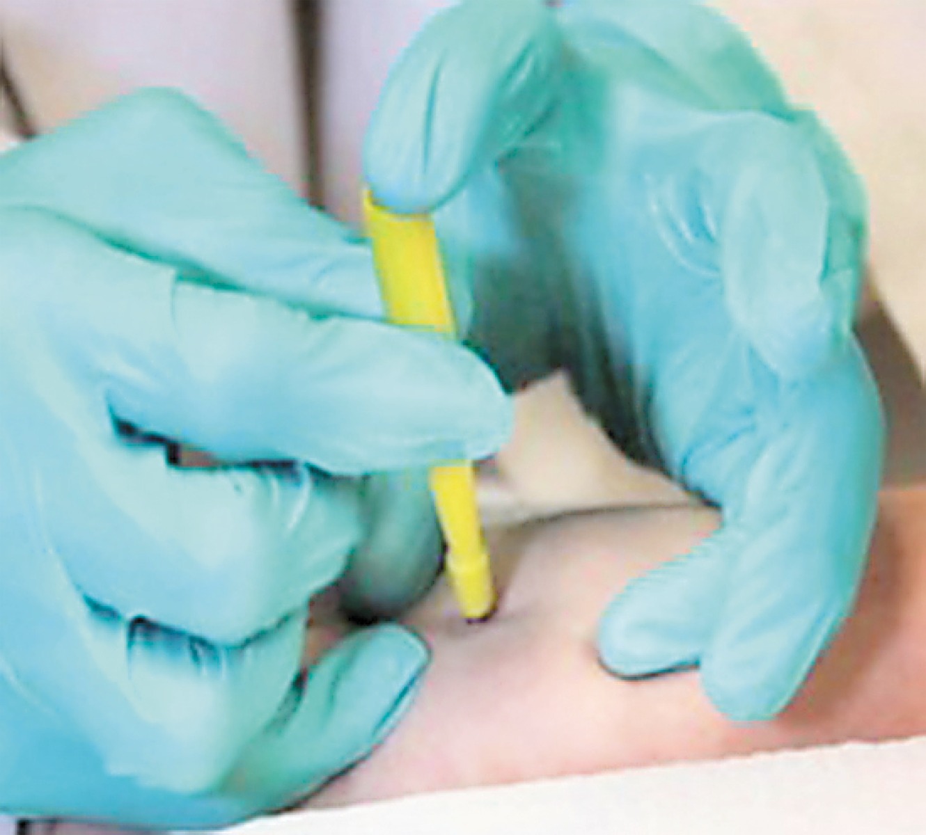 Disposable Biopsy Punch Standard