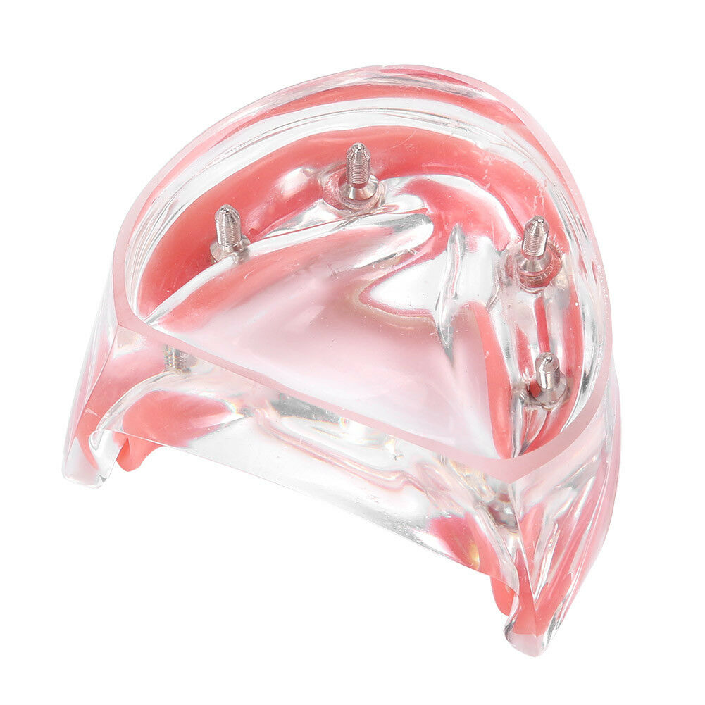 iDENTical Mandibular Overdenture Model with 4 Implants M6003