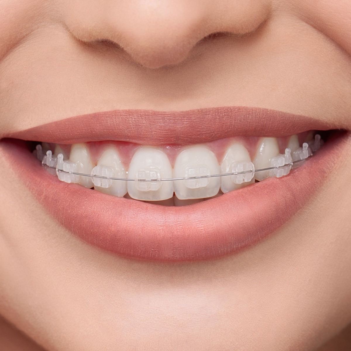 OrthoMetric Flexy NiTi Super Elastic Archwires - Rectangular (10/Pk)