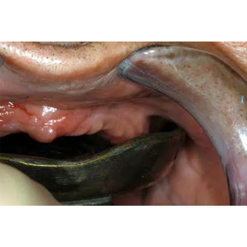 GDC Edentulous Non-Perforated Impression Trays Upper #3 (ITRLEDNPU3)