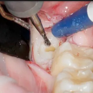 Marathon Straight Surgical Handpiece ES -100N