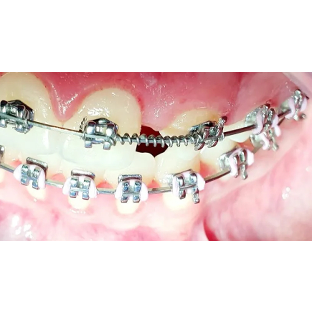 Koden NiTi Open Coil Spring 180mm (Pack of 2)