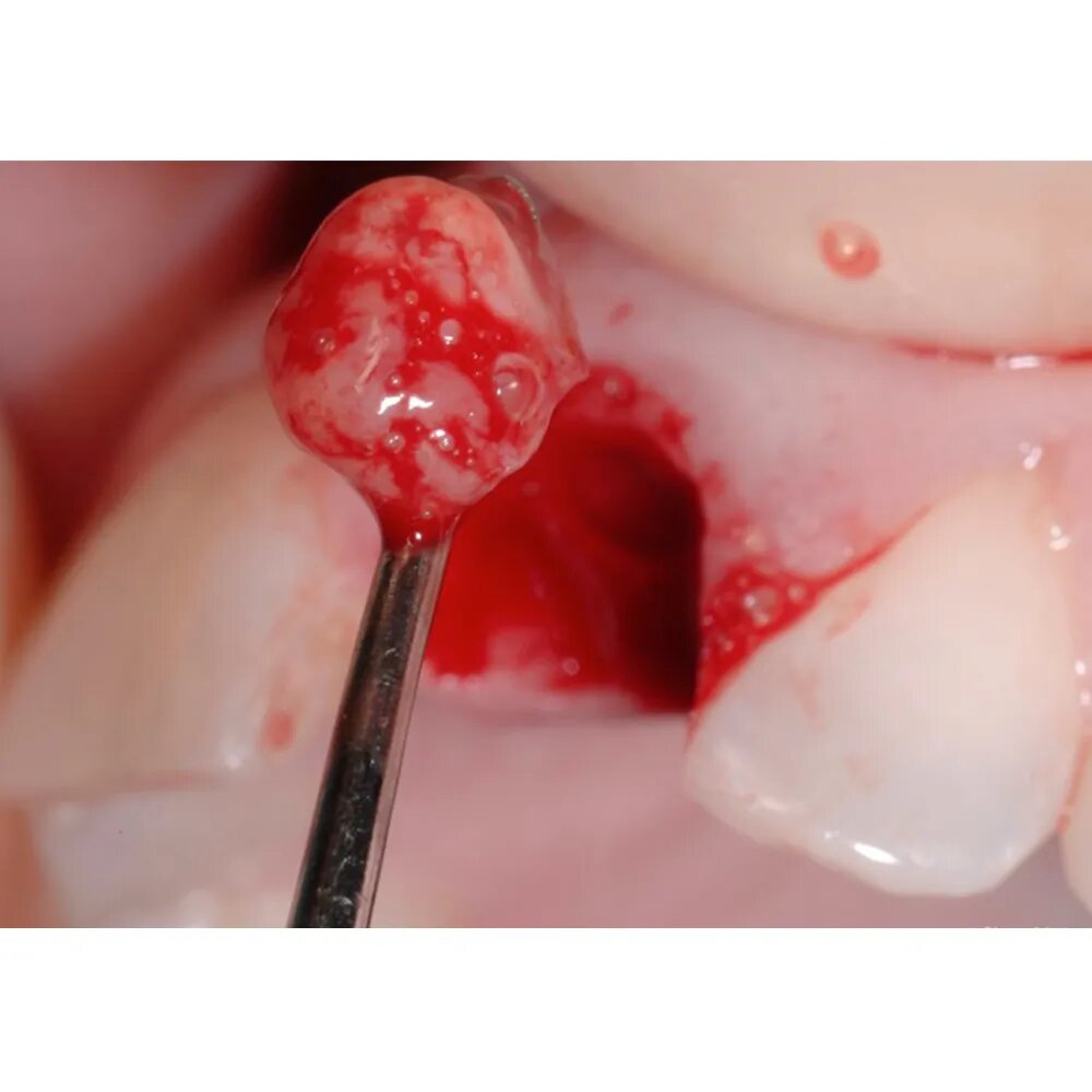 Oracraft Surgical Bone Curettes