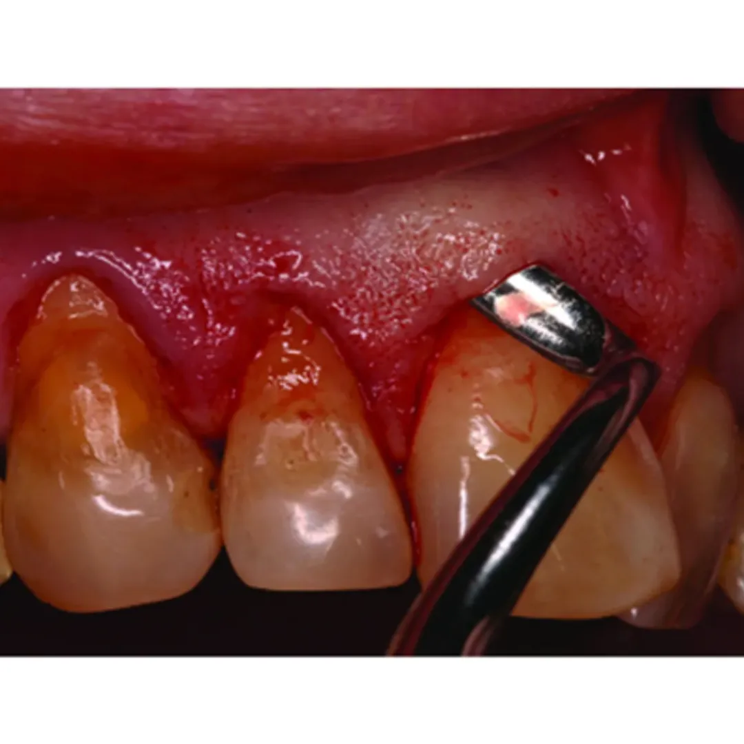 Waldent Periodontal Orban Knife 1/2 (15/769)