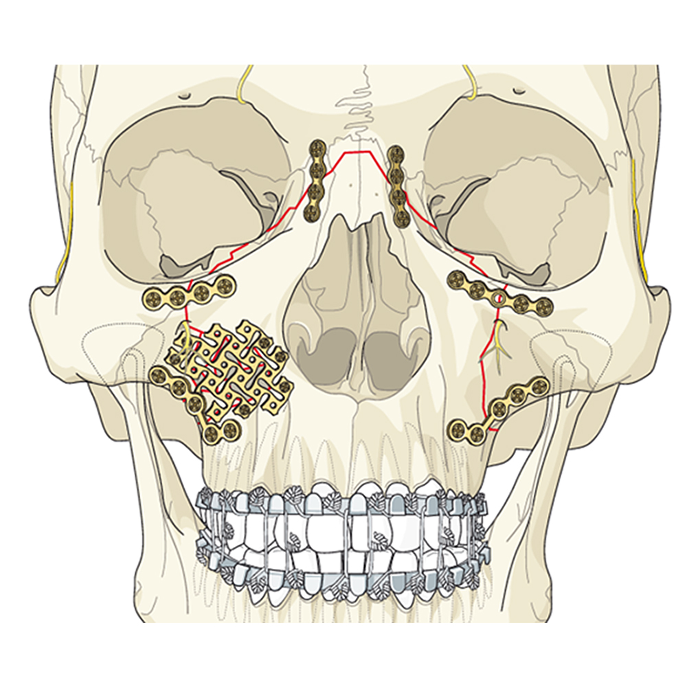 SK Surgicals Titanium Mini Bone Plates L Shape 120° With Gap - 2mm