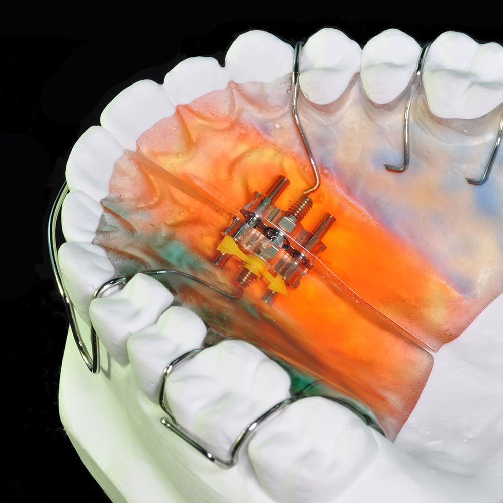 Konark Stainless Steel Orthodontic Wire