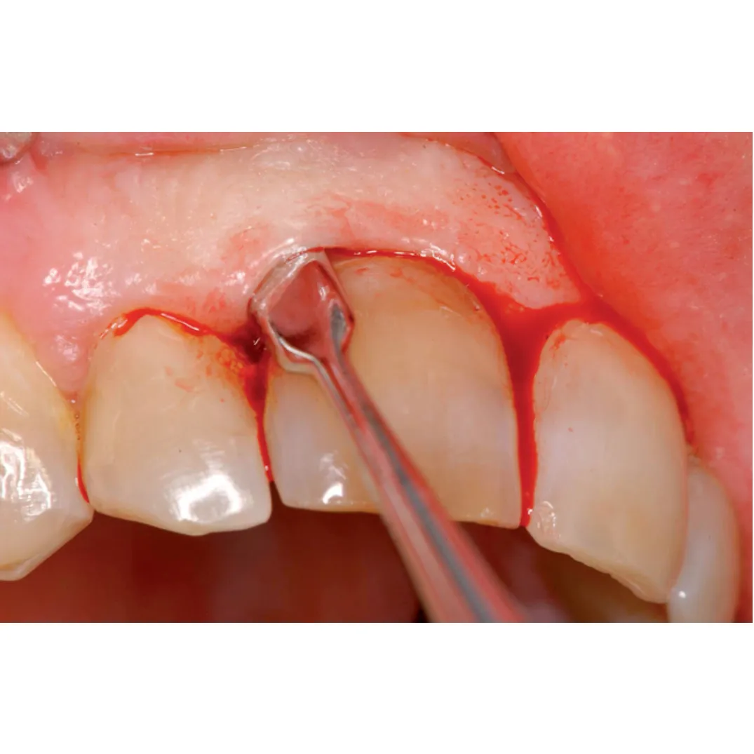 GII Periosteal Elevator