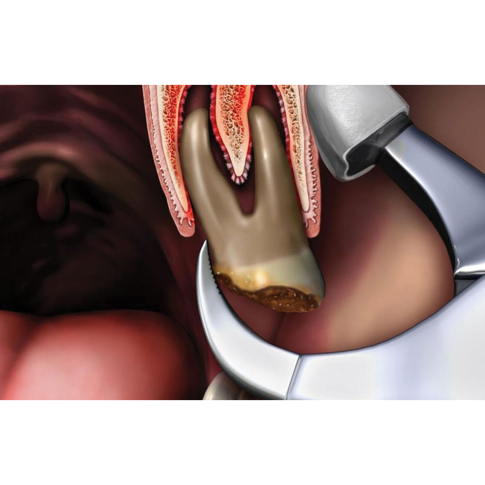 GDC Extraction Forceps Upper Left Physical (Pafx100ul)