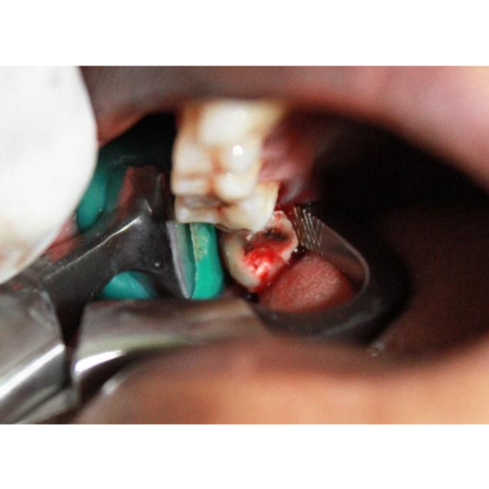 GDC Extraction Forceps Upper Right Physical (Pafx100ur)