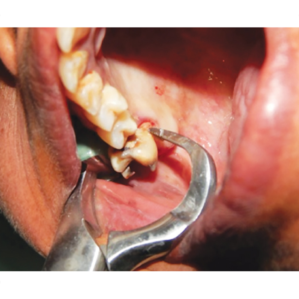 GDC Extraction Forceps Upper Right Physical (Pafx100ur)