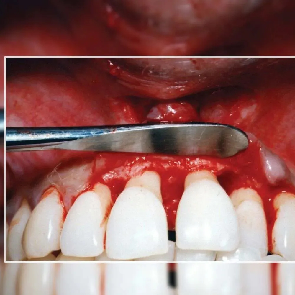 GDC Periosteal Elevator Benque - 6 (Pbq1)