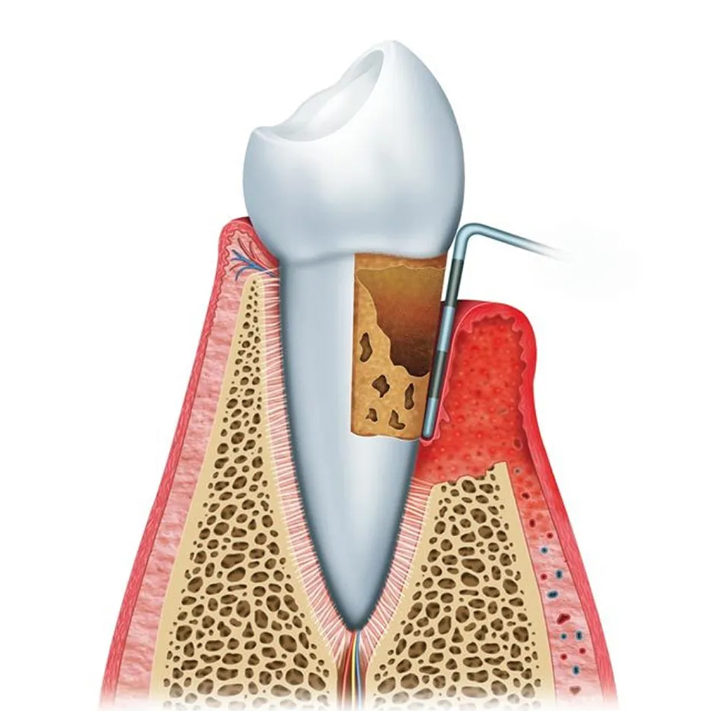 GDC Double End Probes Cp12 / Thin William #6 (Pcp12/Qow6)      
