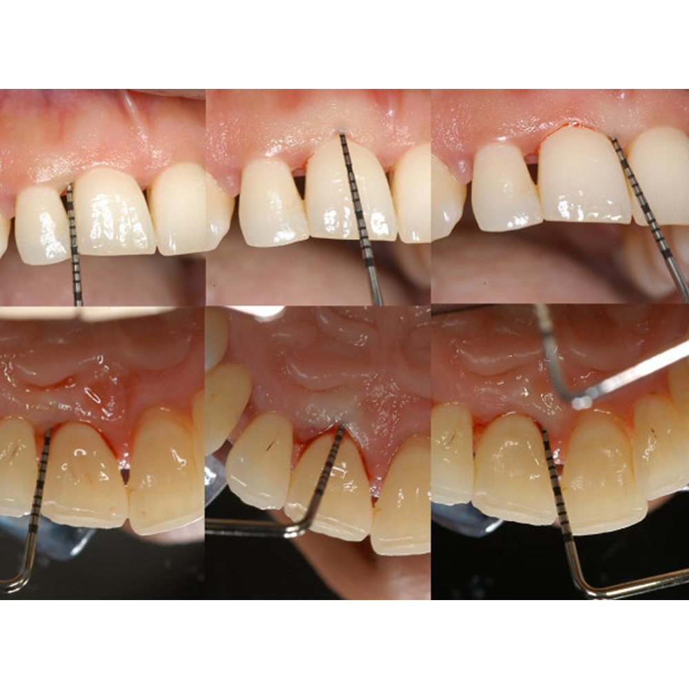 GDC Single End Probes University Of North Carolina #4 (Pcpunc15)