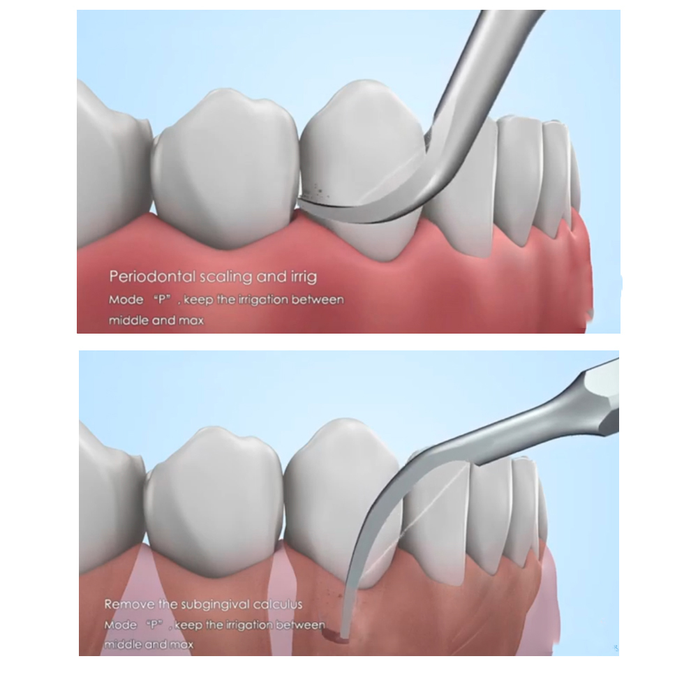 Woodpecker Scaler Tip PD1 for DTE & Satelec Scalers