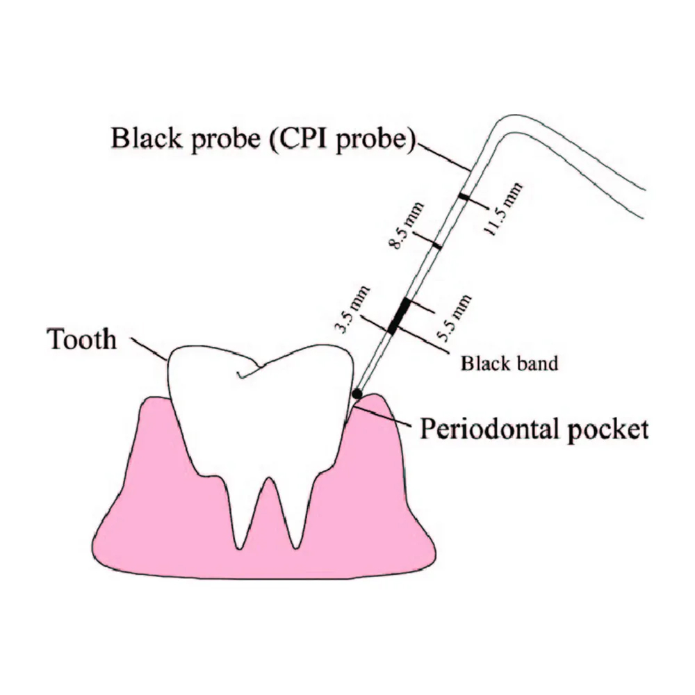 GDC Double End Probes Unc 15 / Screening Probe #1 (PCP15/11.5)