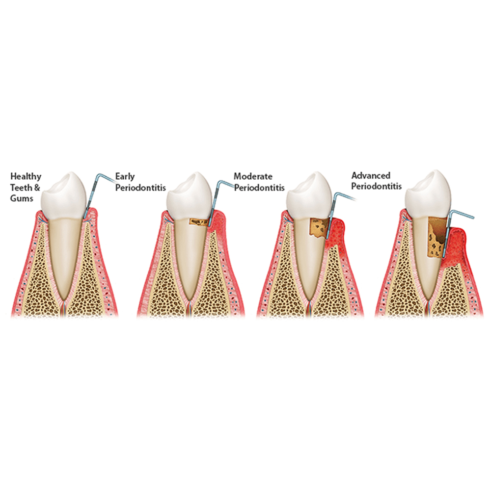 GDC Double End Probes Unc 15 / Screening Probe #1 (PCP15/11.5)