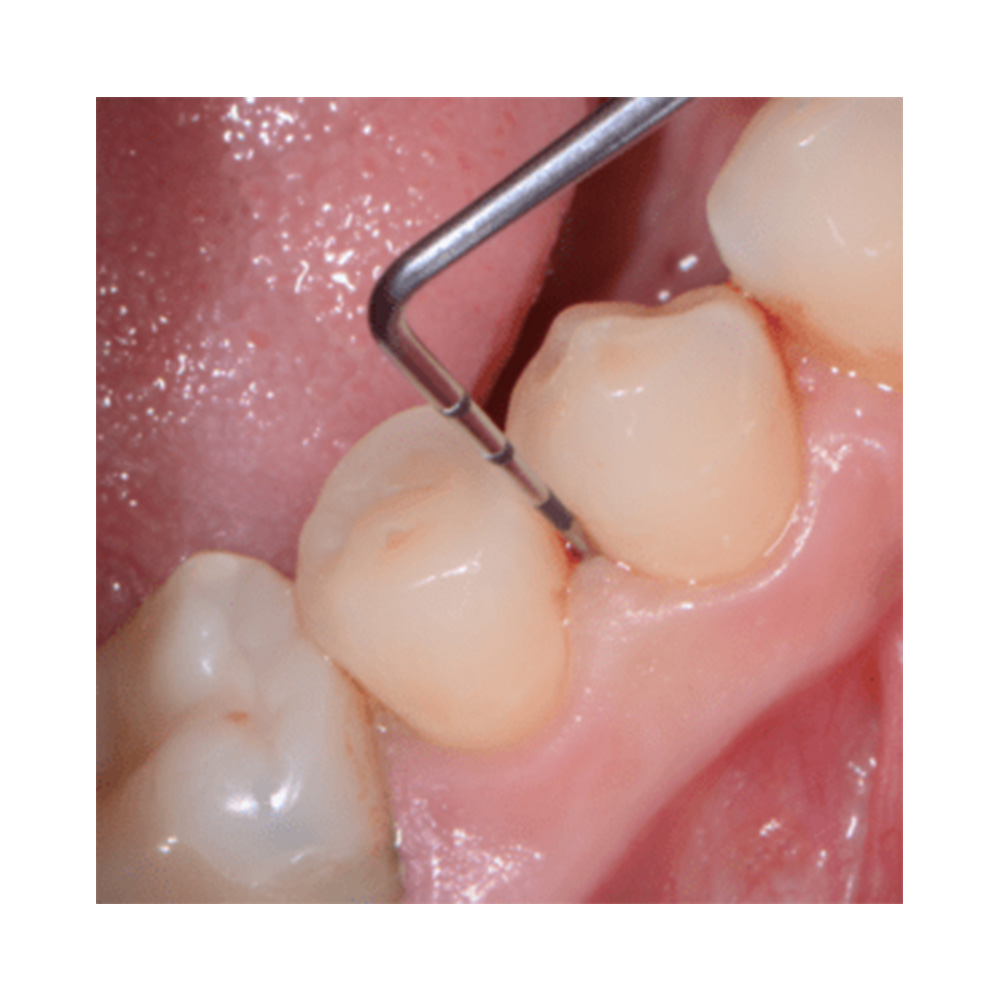 GDC Single End Probes #1 (Pcp11.5b)