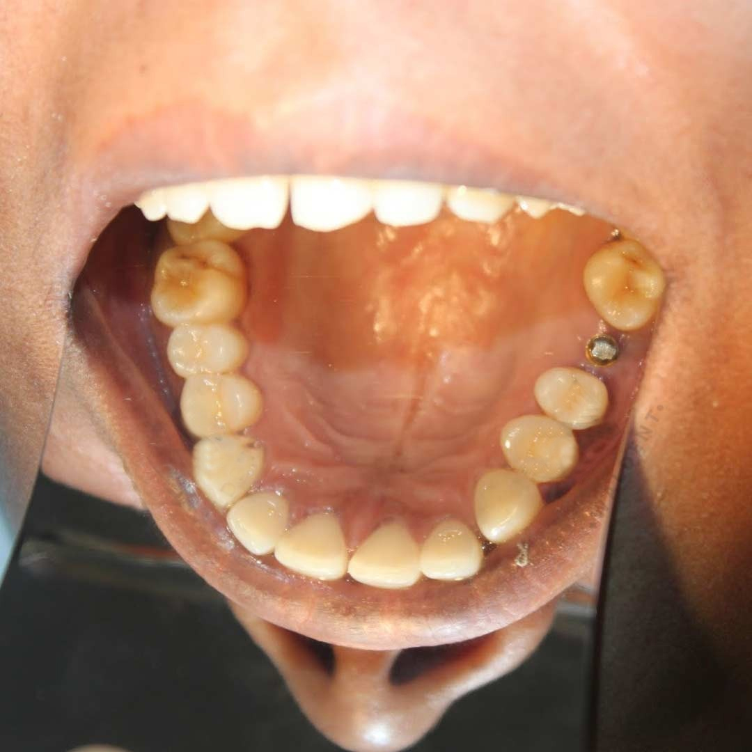 Waldent Photographic Mirror Stainless Steel Set of 6 (K30/2)