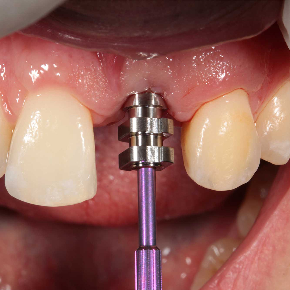 Xcem Conical Pick Up Impression Coping - Non Hex