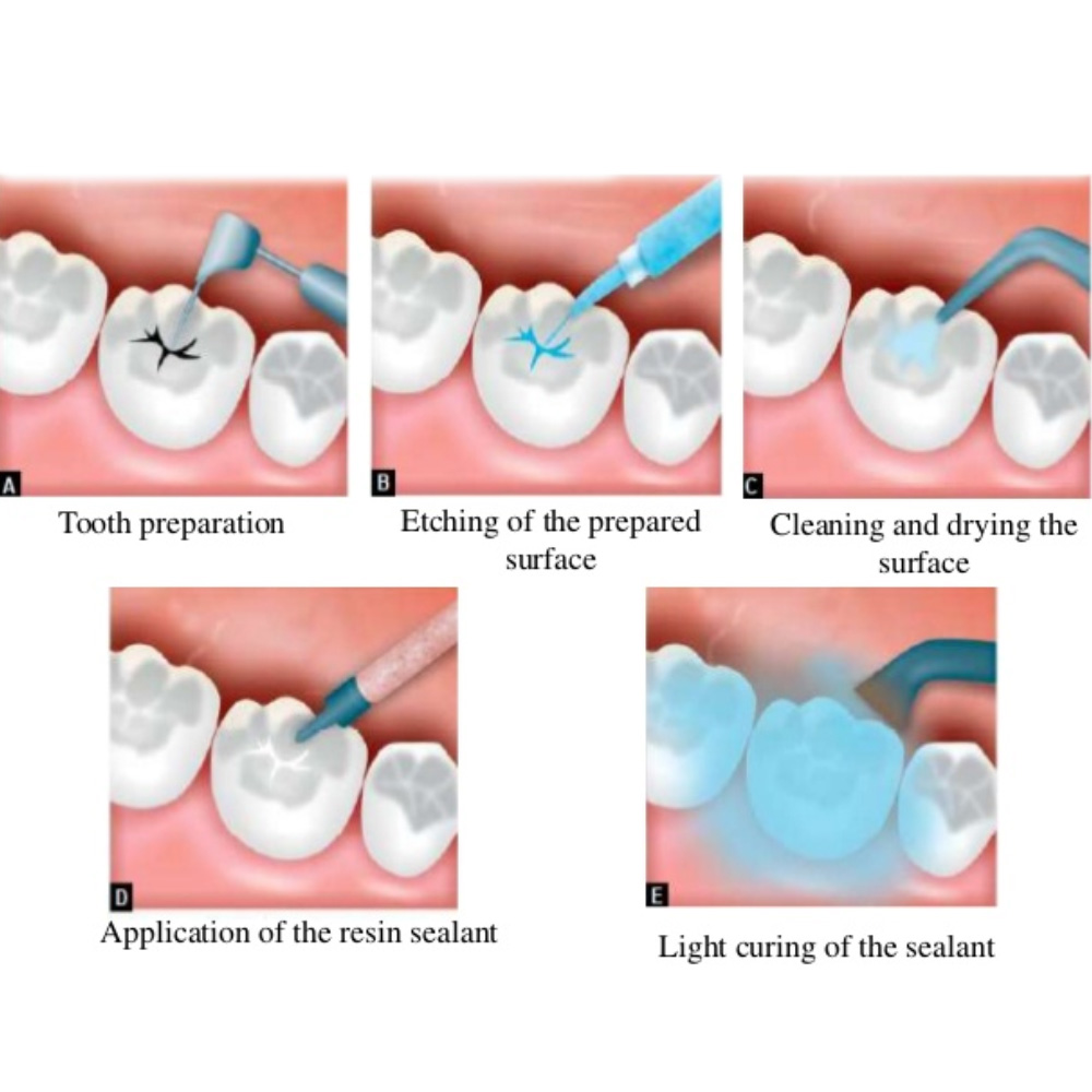 Kids-e-Pit and Fissure Sealant