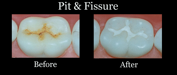Ammdent Pit & Fissure Sealant
