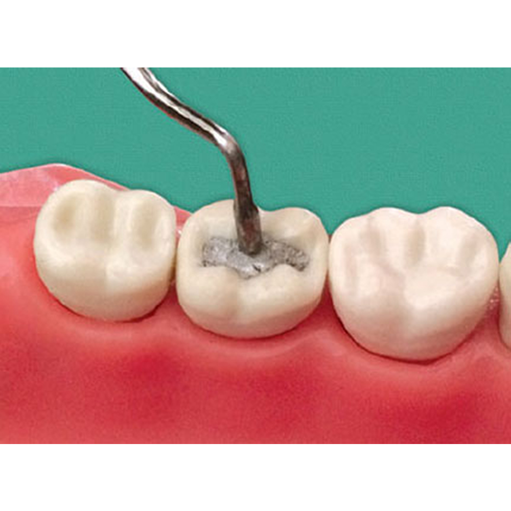 GDC Plugger/Condenser Non Serrated -4 (Plg1l)